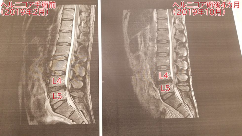 ヘルニコア手術前後のMRI画像の比較