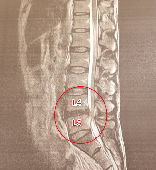 ヘルニコア手術後(4カ月)のMRI画像